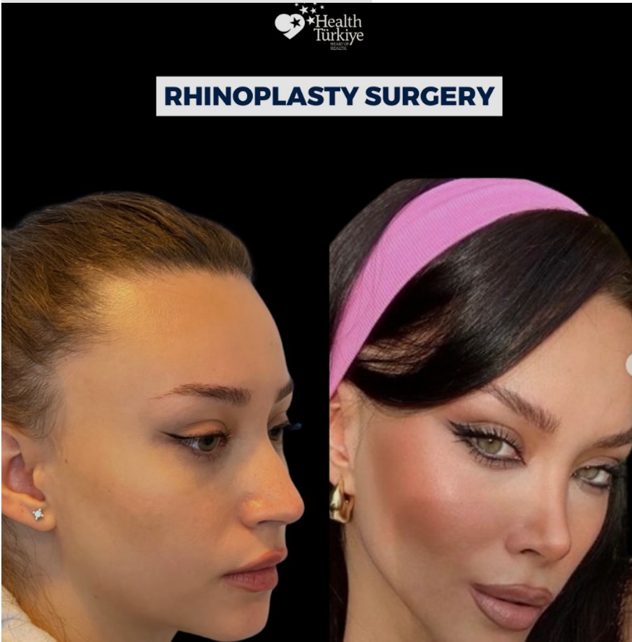 Türkiye’nin En İyi Rinoplasti Doktorları (2026 Liste)